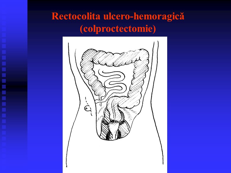 Rectocolita ulcero-hemoragică (colproctectomie)